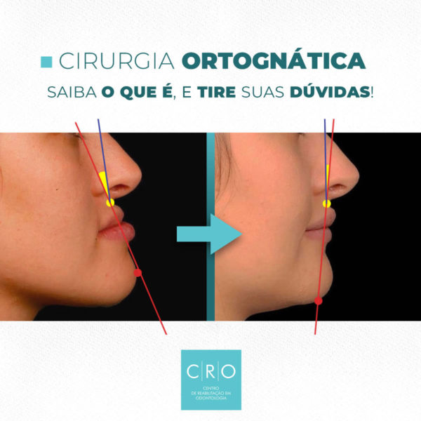 Cirurgia ortognática: antes e depois da cirurgia maxilar